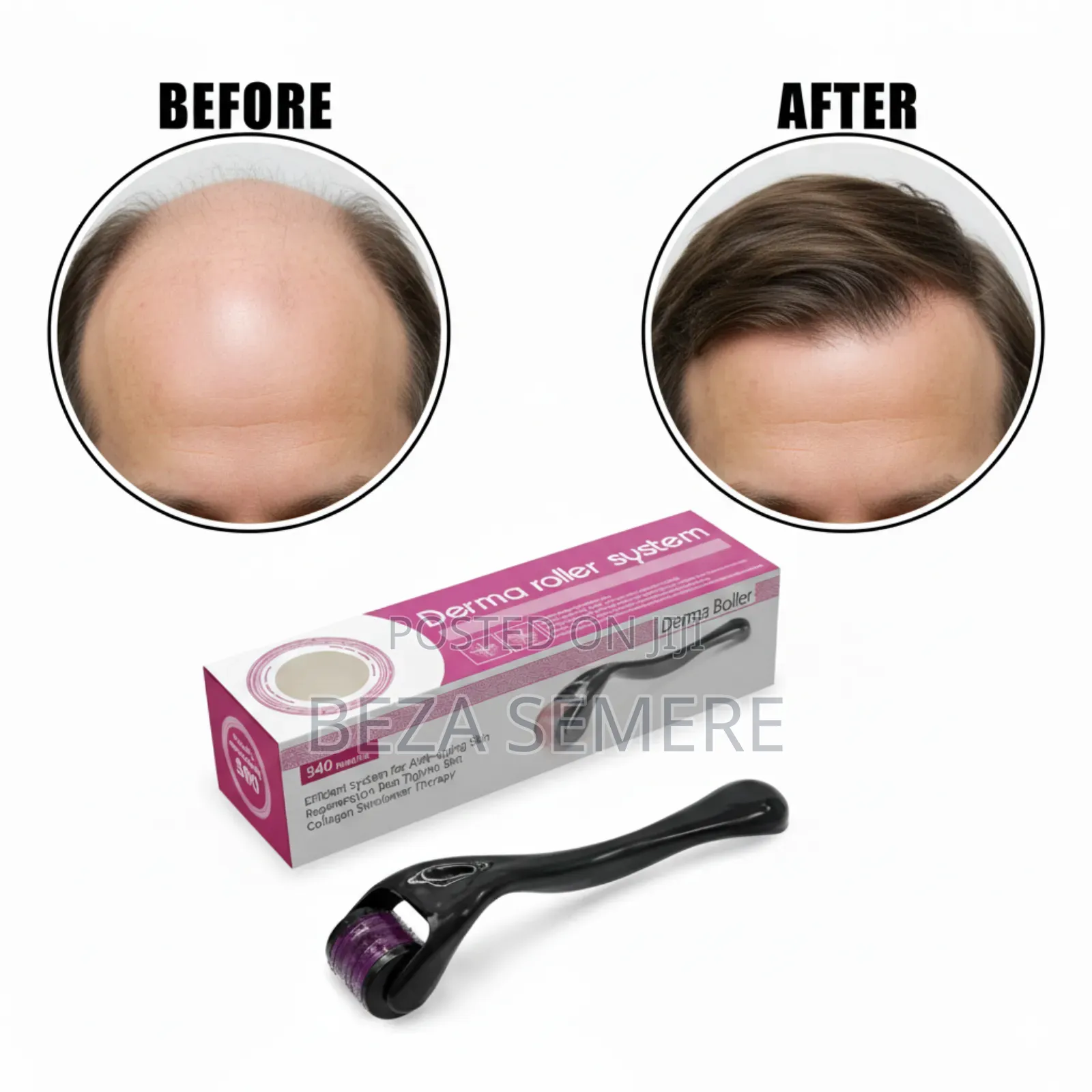 Derma Roller Hair Regrowth Anti Bold