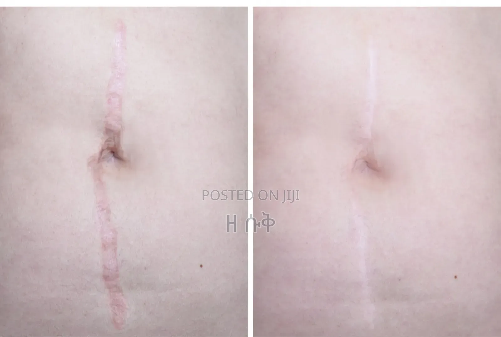 Orignal Collagen ጠባሣ ማጥፍያ