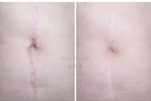 Orignal Collagen ጠባሣ ማጥፍያ