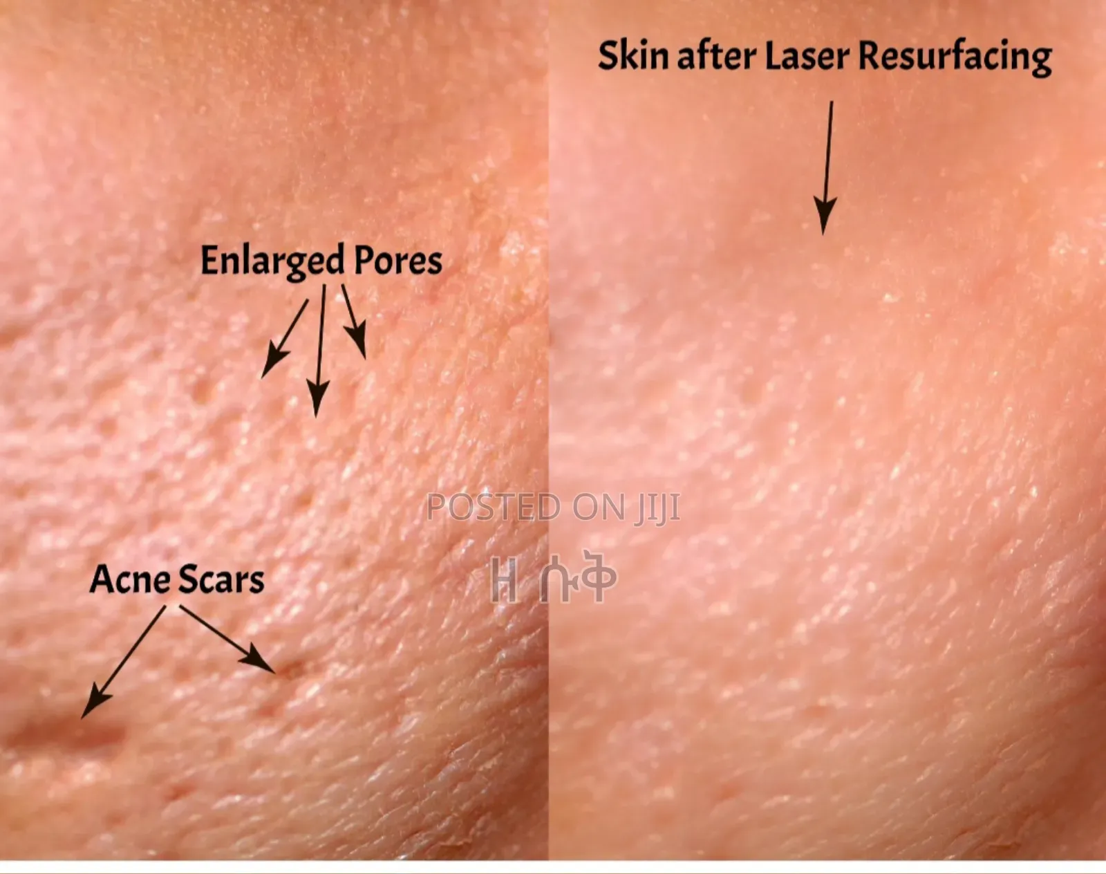 Orignal Collagen ጠባሣ ማጥፍያ