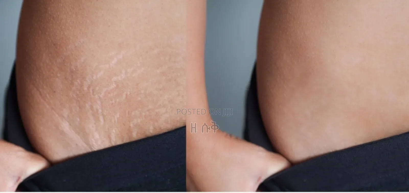 Orignal Collagen ጠባሣ ማጥፍያ