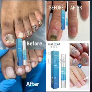 Photo - Nail የጠቆረ ጥፍር የሌለው አዲስ ጥፍር ያበቅላል