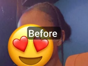 Hair Growth Minoxidil