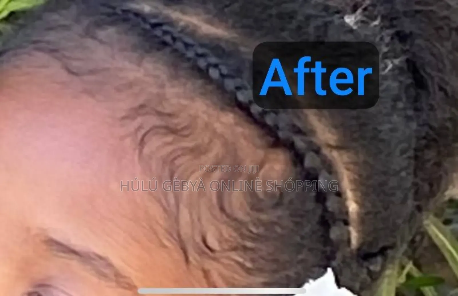Hair Growth Minoxidil