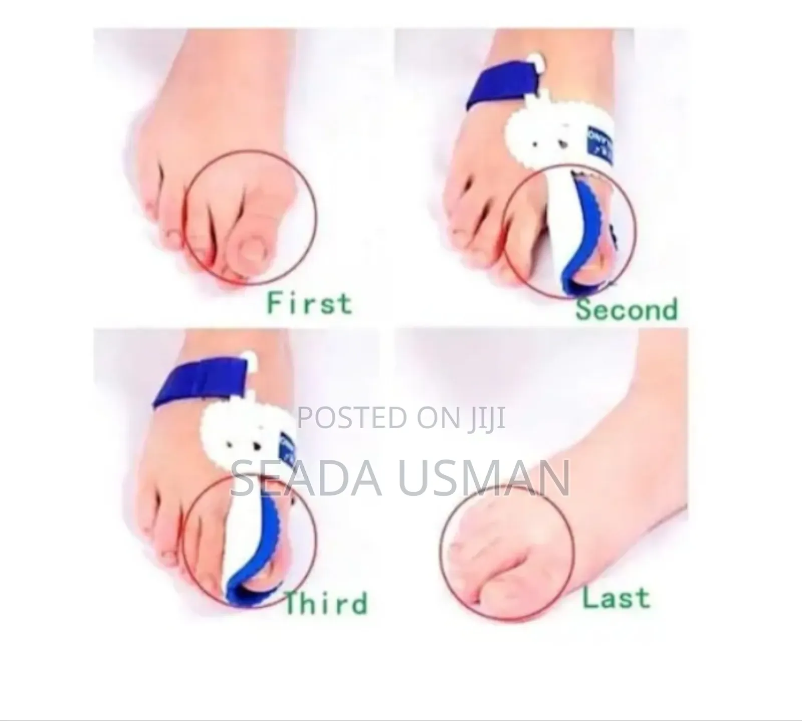 የአውራ ጣት ማስተካከያ(Bunion Corrector)