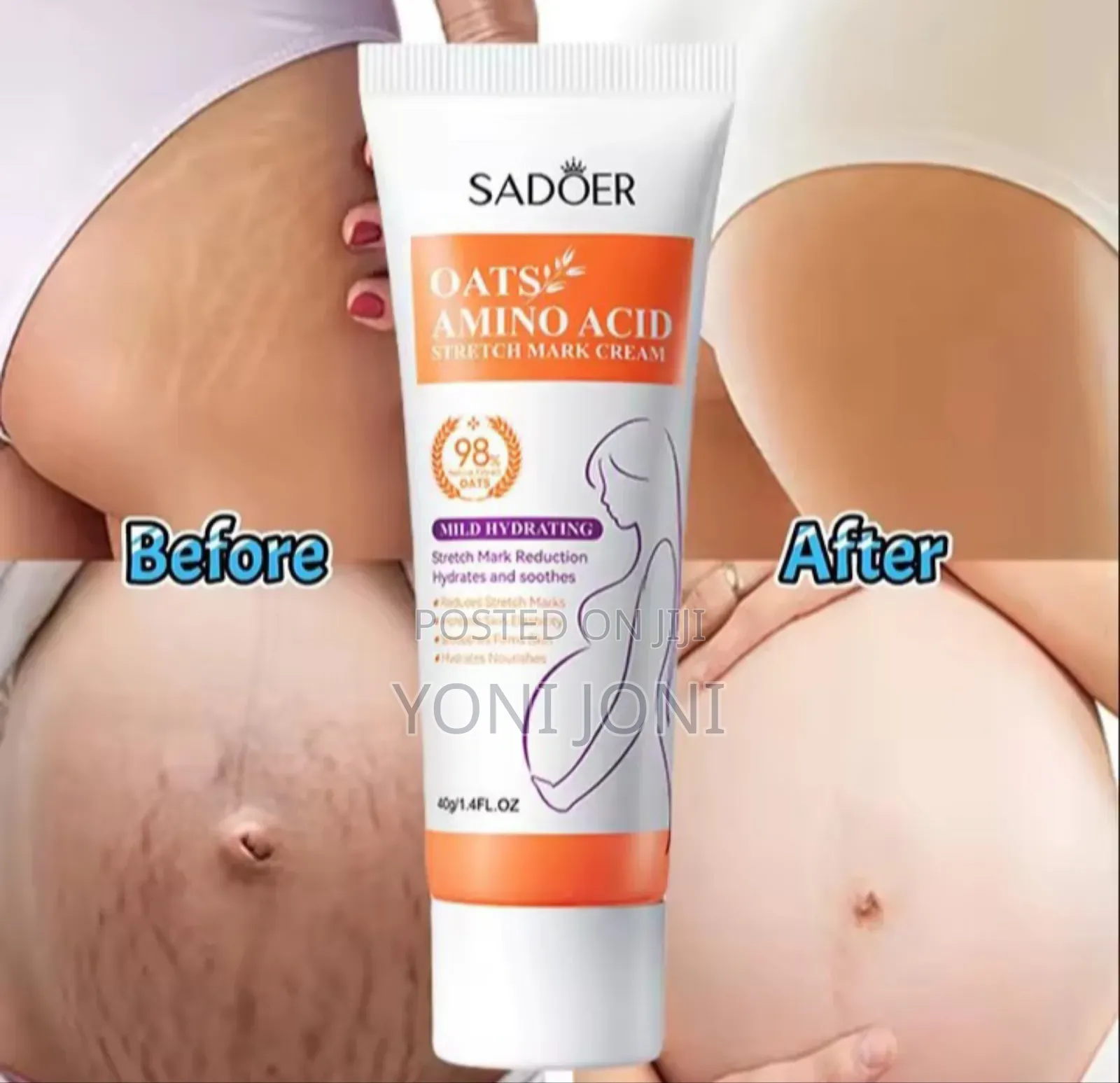 Streach Mark Removal