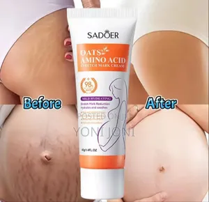 Photo - Streach Mark Removal