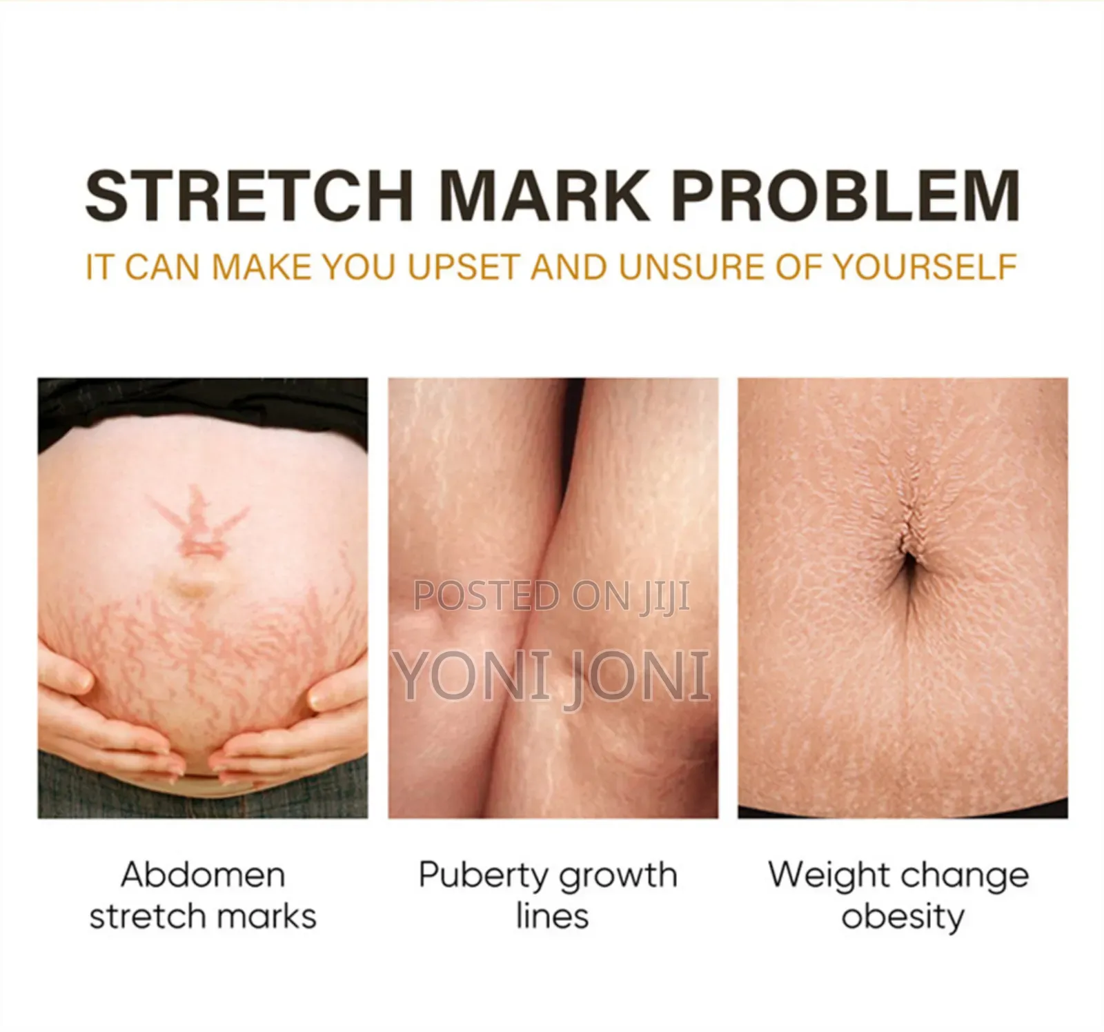 Stretch Mark Removal Cream