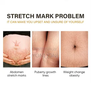 Stretch Mark Removal Cream