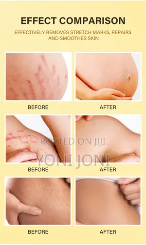 Stretch Mark Removal Cream