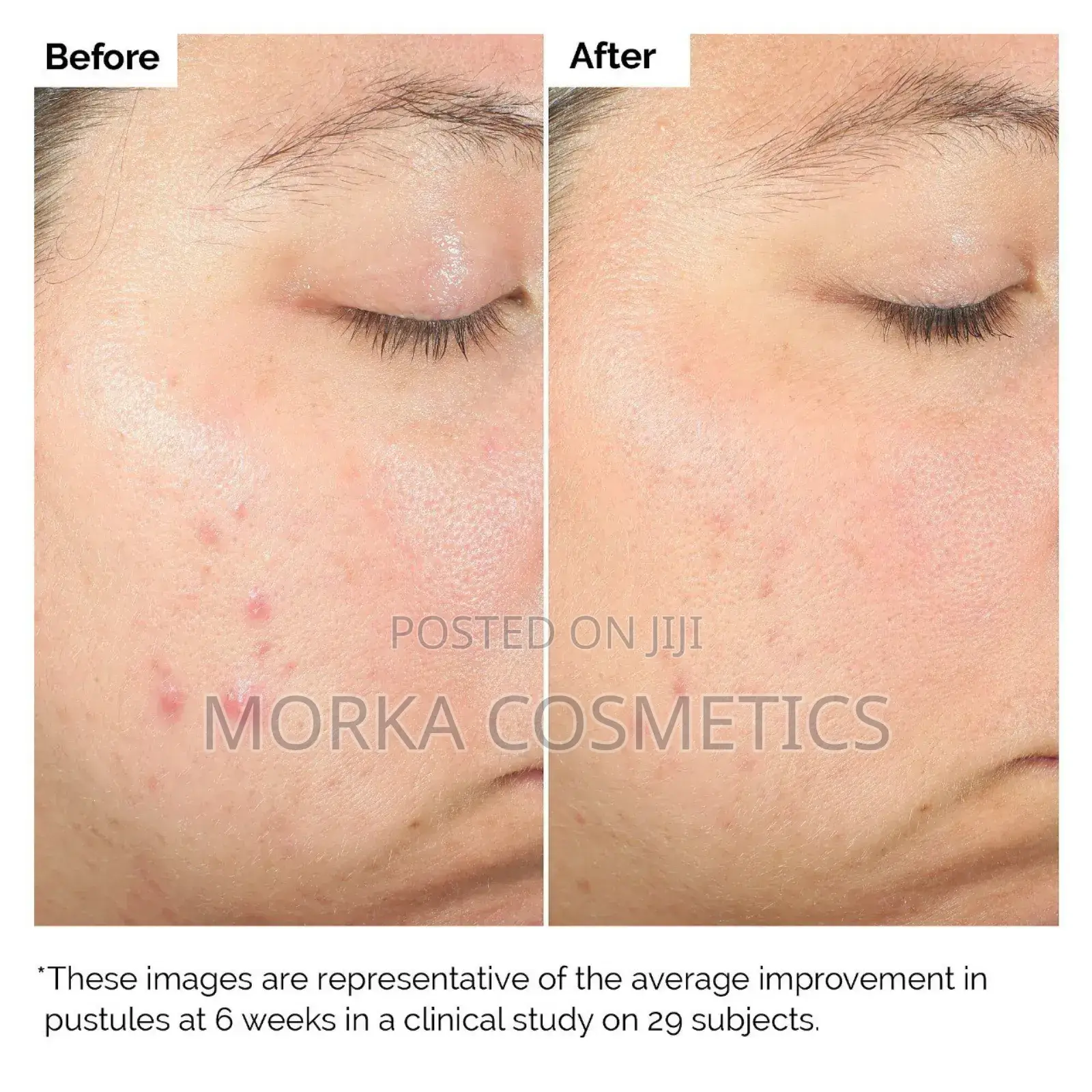 Salicylic Acid 2% Solution