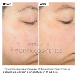 Salicylic Acid 2% Solution