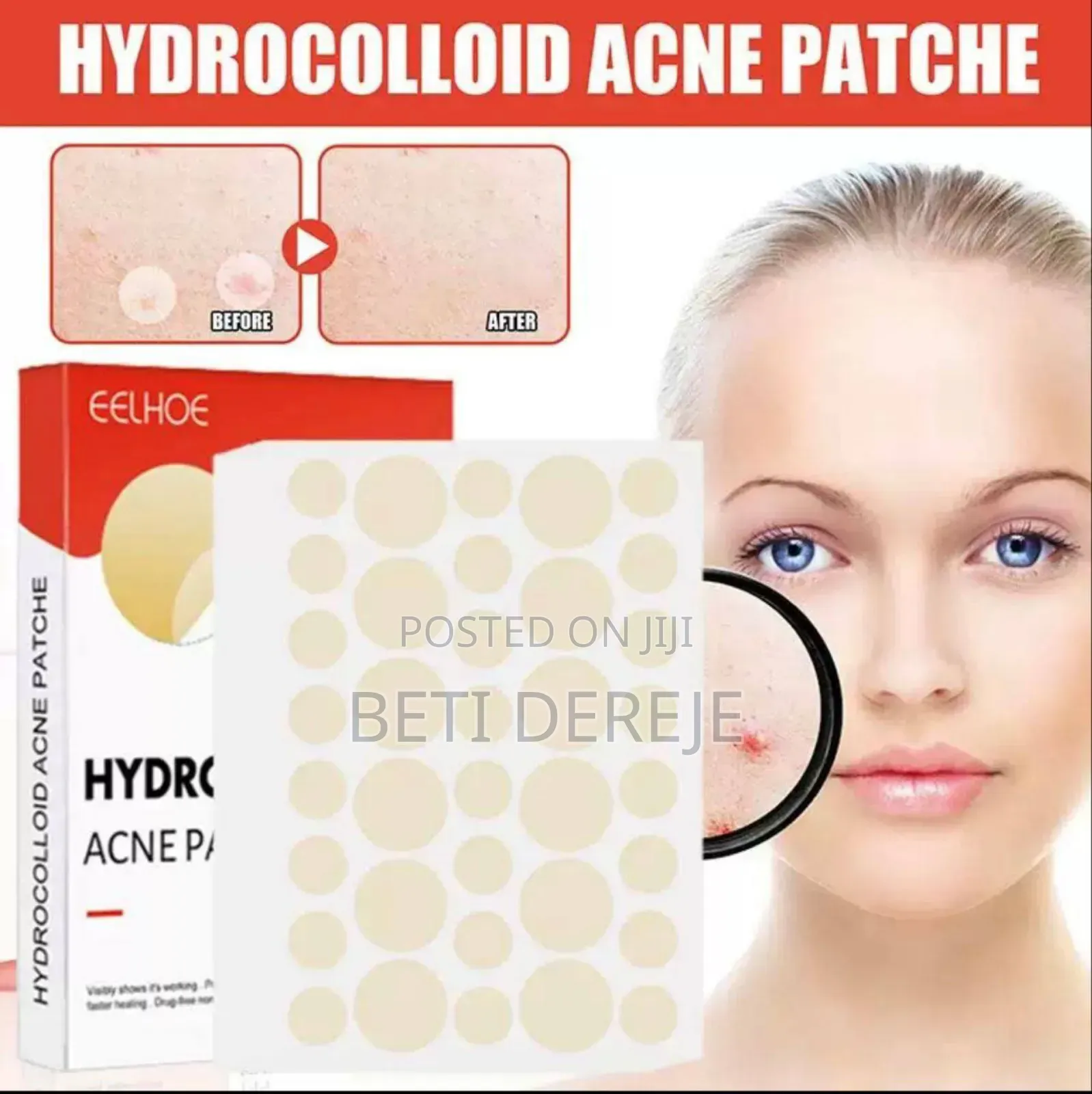 Hydrocolloid Acne Pimple Patch
